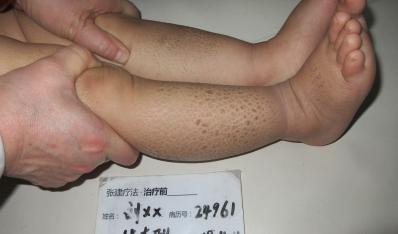 微信群里巧遇病友，意外治好多年魚鱗病